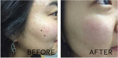 Fivfivgo™ WipeOff Tags & Mole Remover