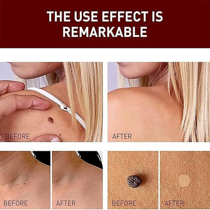 Fivfivgo™ WipeOff Tags & Mole Remover